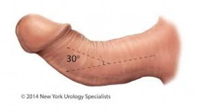 30 degree curvature