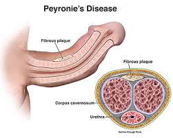 Abnormal penile curvature